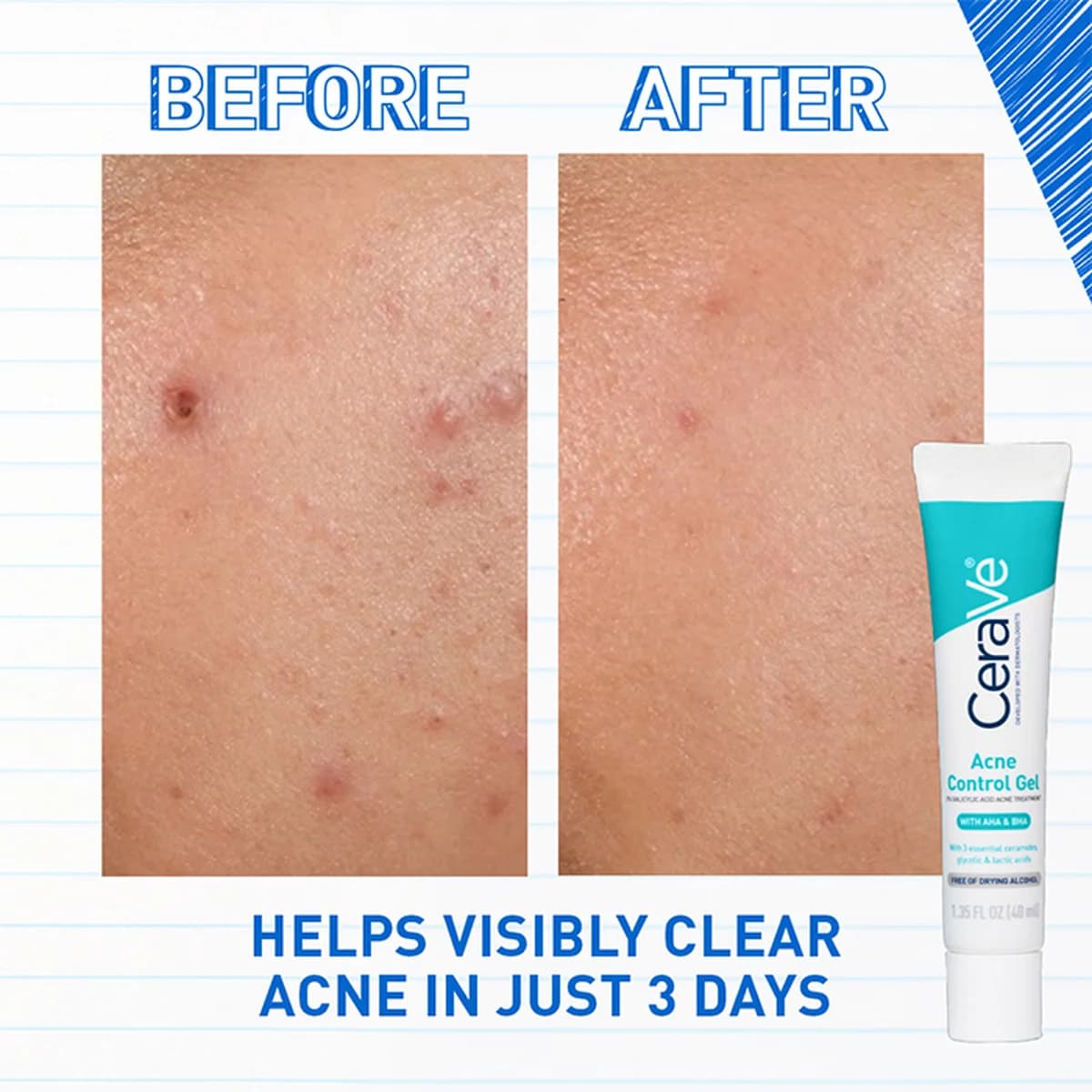 Cerave Acne Control Gel For Acne-Prone Oily Skin thumbnail 3