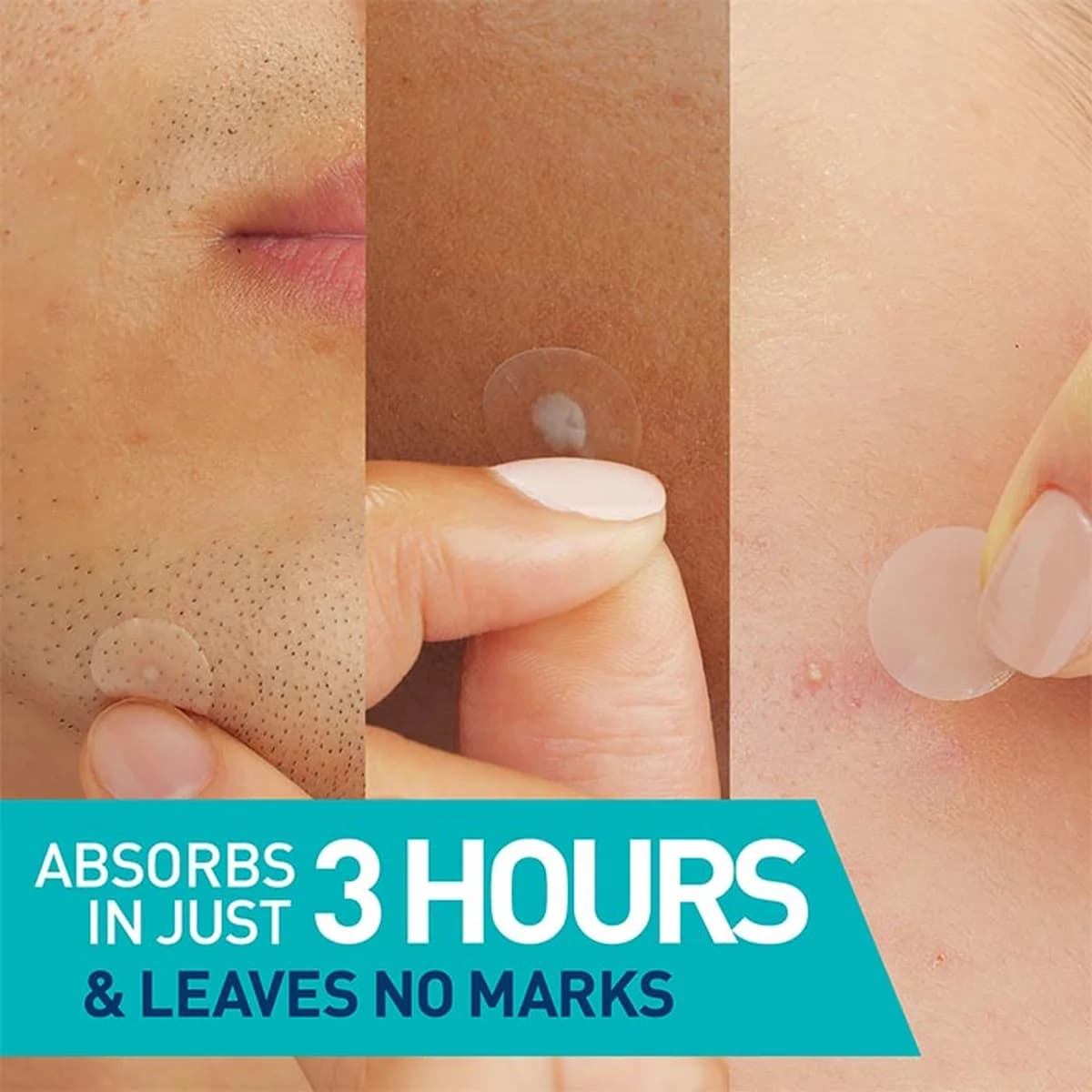 Cerave Blemish Barrier Patches Oily, Blemish-Prone, and Sensitive Skin thumbnail 2