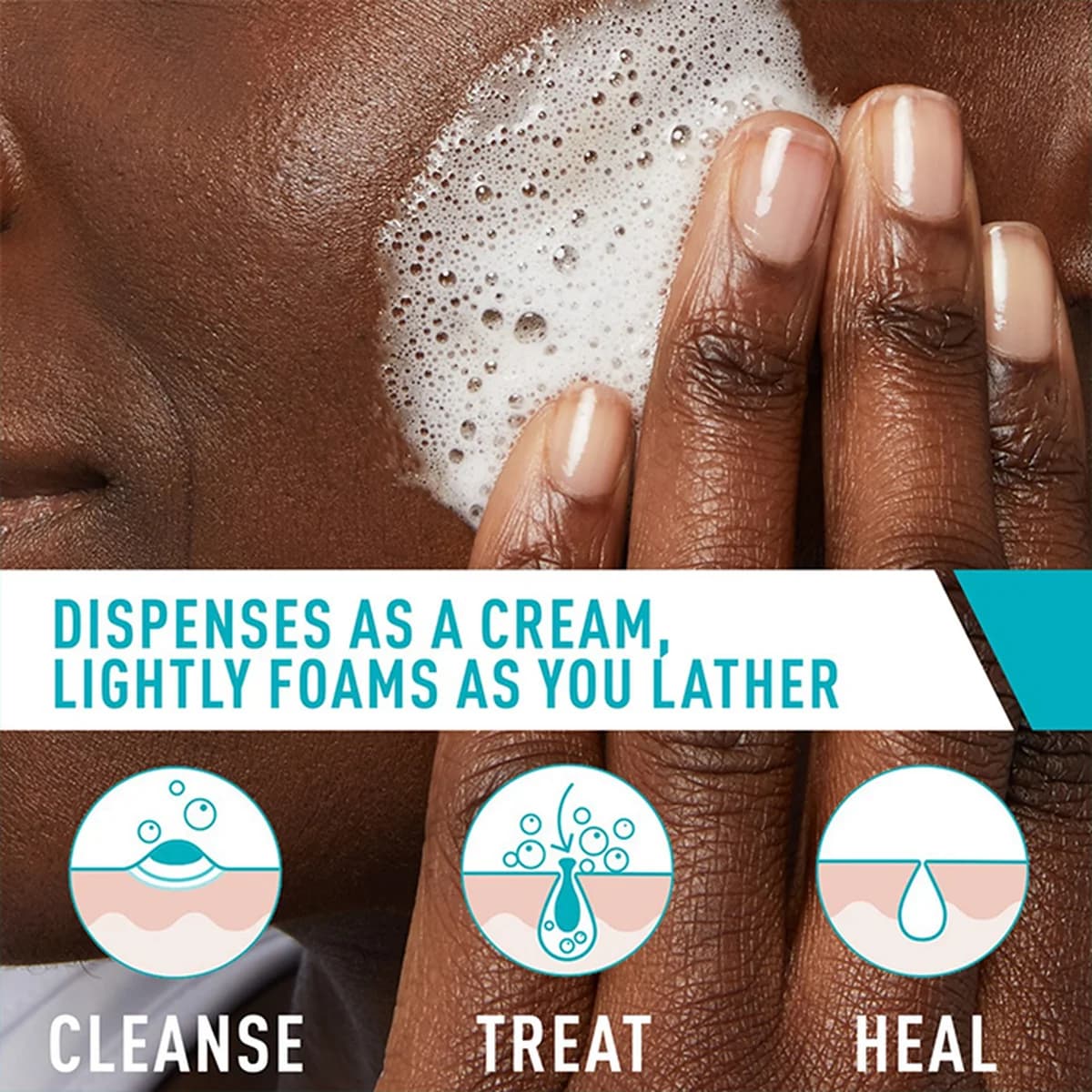 Cerave Acne Foaming Cream Cleanser For Acne-Prone Skin thumbnail 3